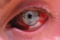 Кръвоизлив в окото