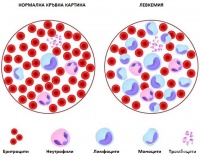Злокачествено заболяване на кръвта