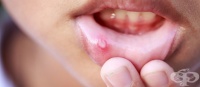 Лезии в устата
