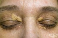 Липса на липопротеин липаза