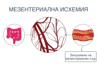 Мезентериална исхемия