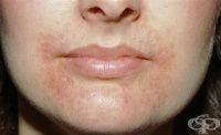 Обрив на устата