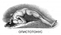 Опистотонус