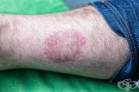 Петна по кожата