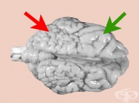 Полимикрогирия на мозъка