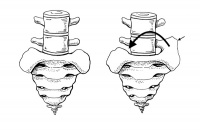 Сакрализация на лумбалните прешлени