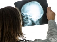 Симптоми на черепа