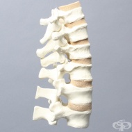 Сплескан гръбначен прешлен