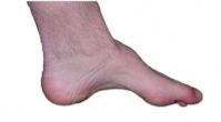 ������� �� ����� (���������� �� Charcot)
