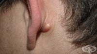 Туморовидна подутина зад ушите