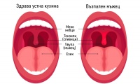 Възпален мъжец