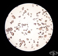 Високо ниво на урати в урината