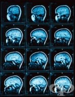 ЯМР на главата