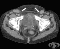 КТ на лимфни възли