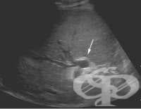 Ултразвуковото изследване (ехография) на жлъчните пътища