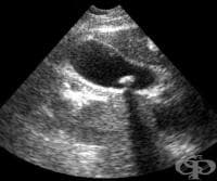 Ултразвуковото изследване (ехография) на жлъчен мехур