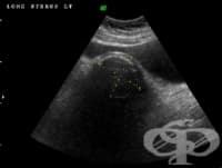 Тазова ехография