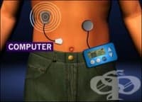 Изкуствен панкреас