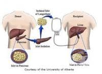 Трансплантация на островни клетки