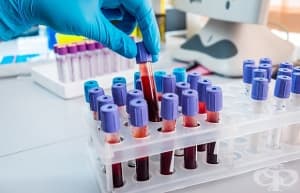 Склонността към деменция ще се определя с кръвен тест