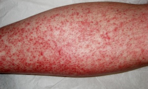 DRESS синдром