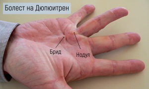 ����������� �� ���������� ���������� [Dupuytren]