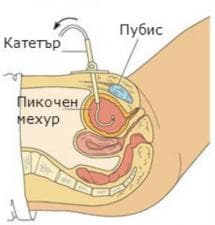 Грижа за цистостома