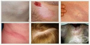 ������������ ������������ [morphea]
