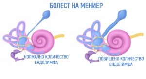 Болест на Meniere