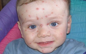 ������� [varicella]