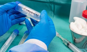 НЗОК няма да заплаща биомаркерната диагностика за онкоболните