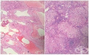 Клинична патология на хемангиом на черния дроб