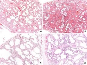 Кличнична патология на идиопатична белодробна фиброза