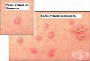 Какви са симптомите и признаците при варицела?