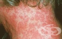 Simptome varicoză internă pelvis Simptome vene varicoase interne în pelvis