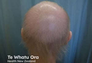 Синдром на анагенно отпадане на косата