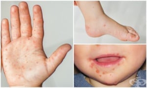 Инфекция с коксаки вирус: болест ръка-крак-уста