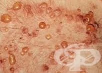 Vis de picior cu vene varicoase, Îmbolnăvește-te într-un vis cu vene varicoase