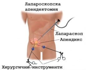 Лапароскопска апендектомия