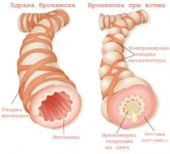 Патофизиология на бронхиалната астма