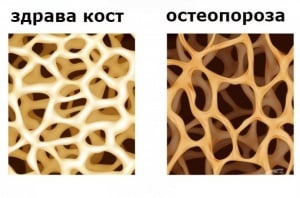 Остеопороза: костно ремоделиране