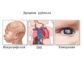 Какво представлява вродената рубеола?