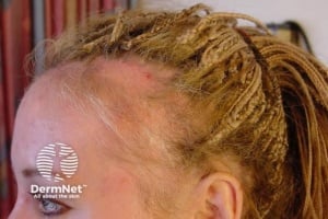 Тракционна алопеция и трихотиломания