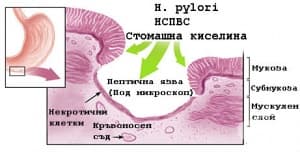 Причини и рискови фактори за поява на язва