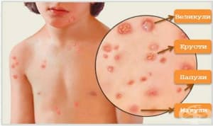 Simptom al schwartz în varicoză, Testele funcționale pentru varice