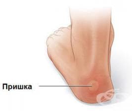 Травматични кожни мехури при спорт (пришки)