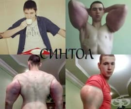 21-годишен руски бодибилдър рискува живота си след инжектиране на синтол в мускулите си