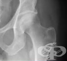 Рентгеново изследване на тазобедрената става