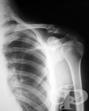 Рентгеново изследване на ключицата