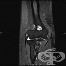 Артрография на лакът